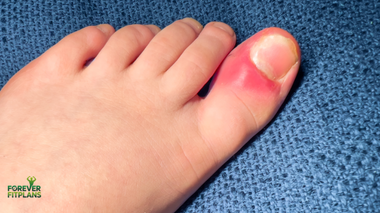 Toenail Fungus Vinegar