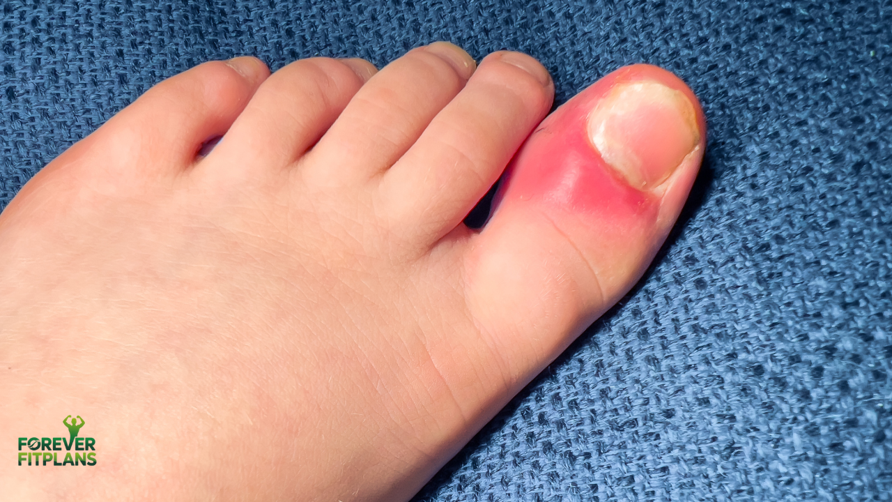 Toenail Fungus Vinegar